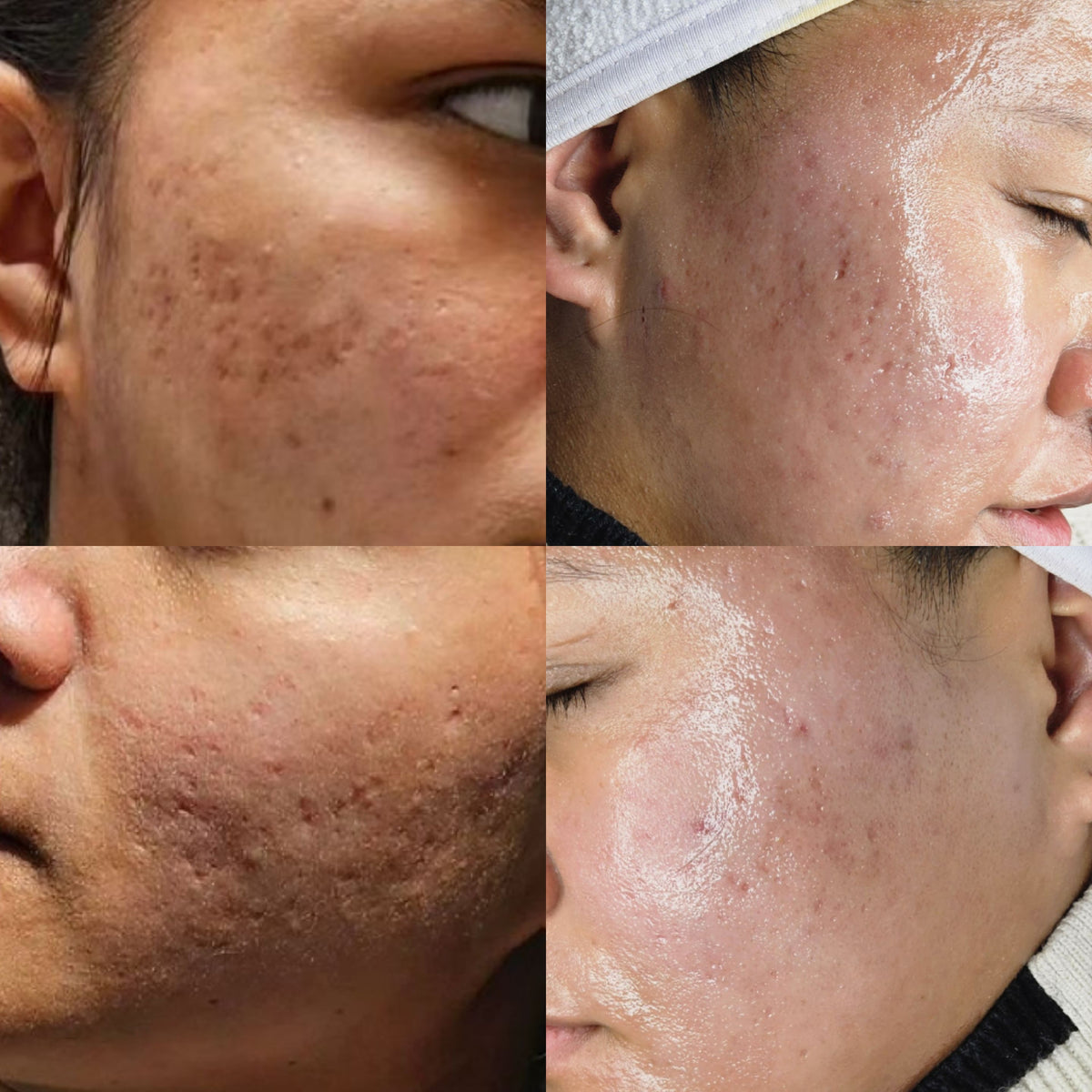 HEXIE Beauty client skin result, gallery image 2