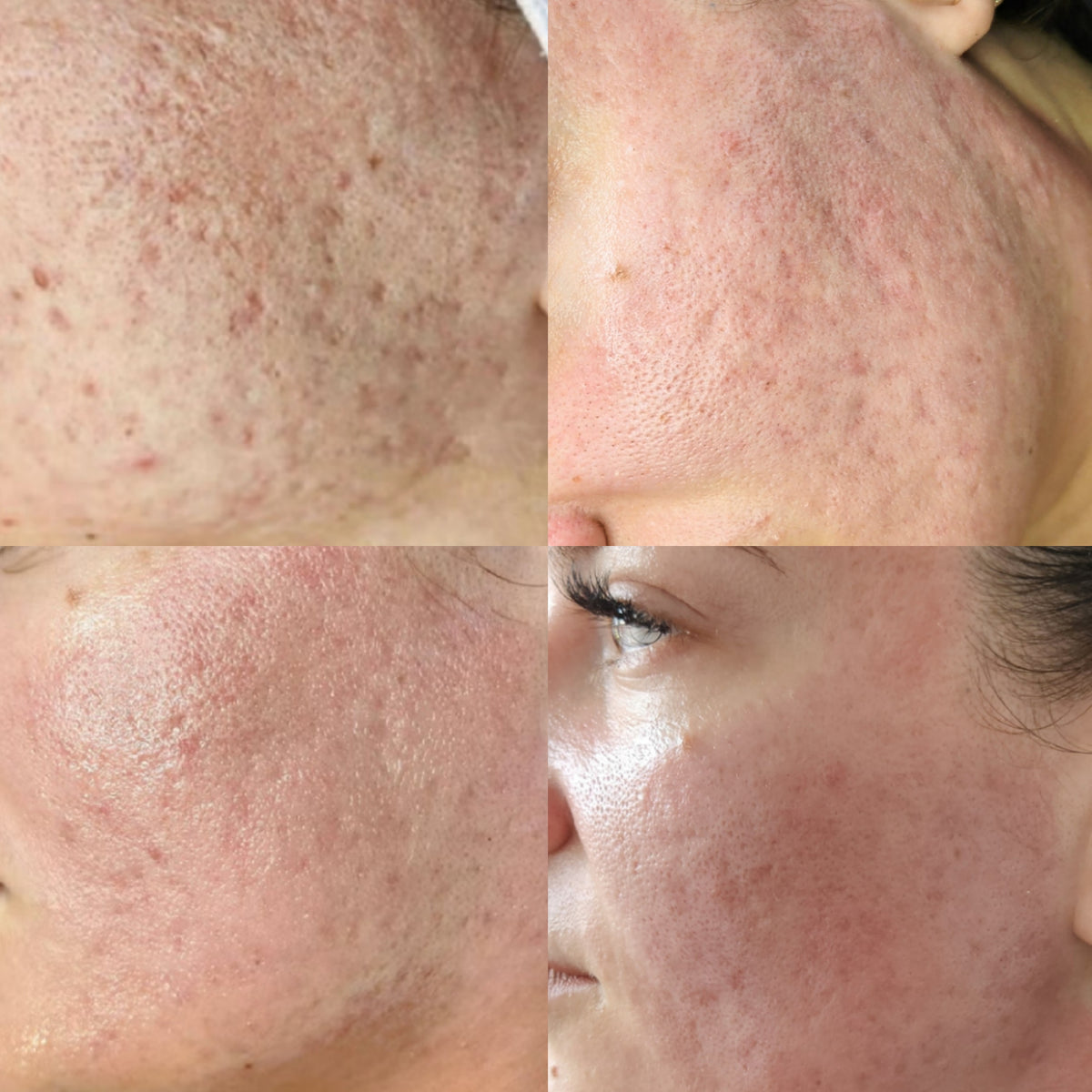 HEXIE Beauty client skin result, gallery image 5