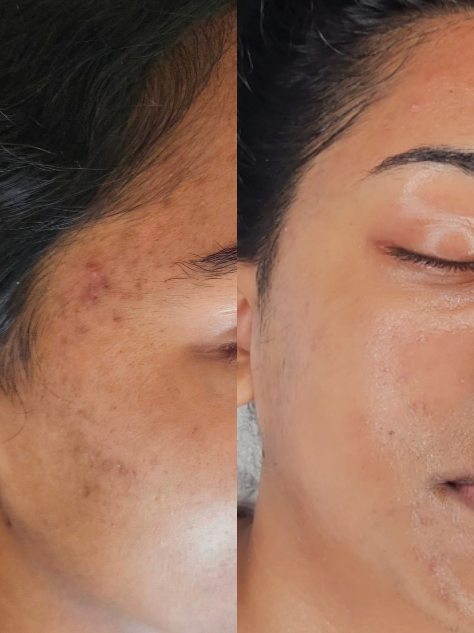 HEXIE Beauty client result or treatment in progress