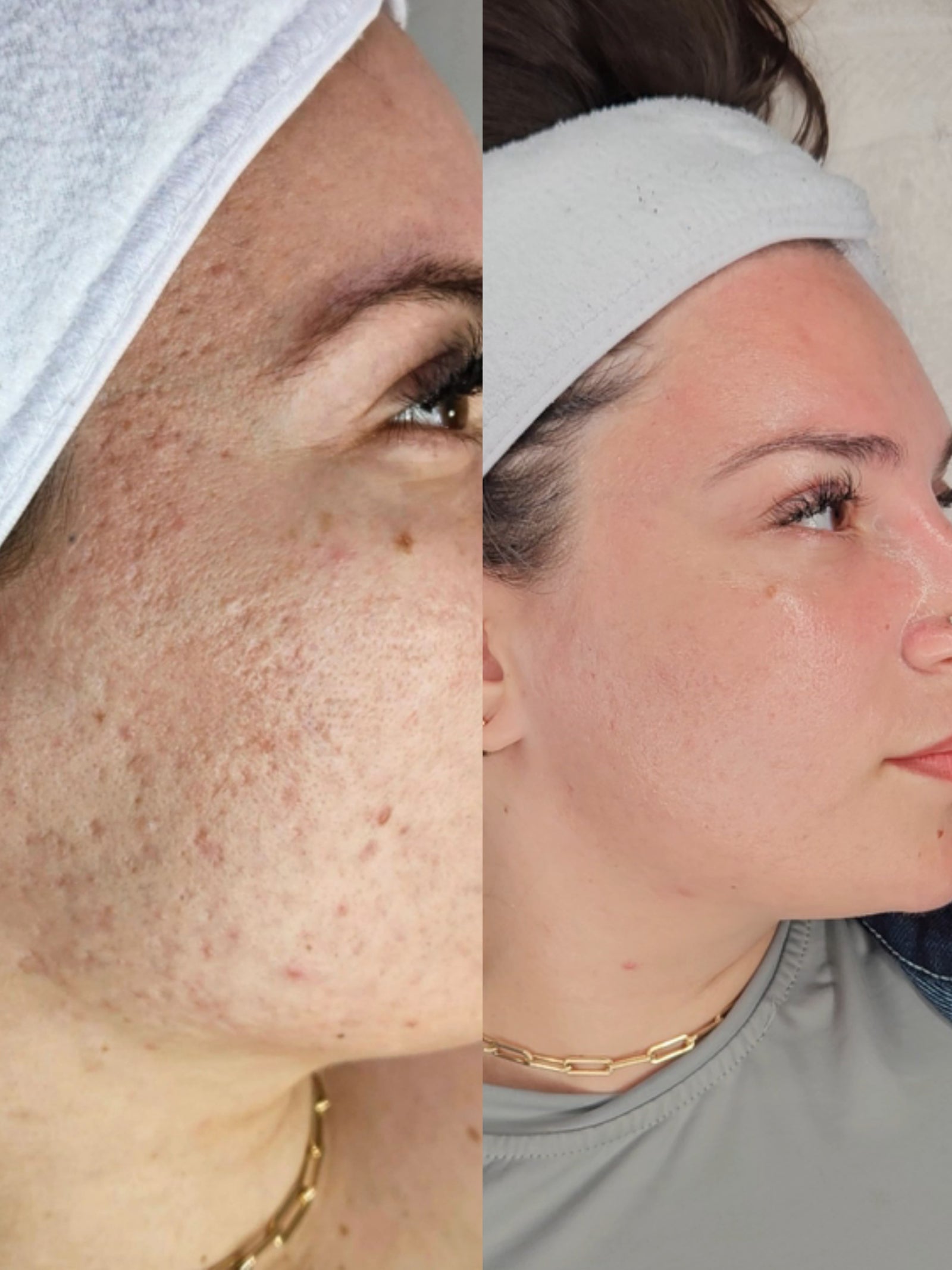 HEXIE Beauty client result or treatment in progress