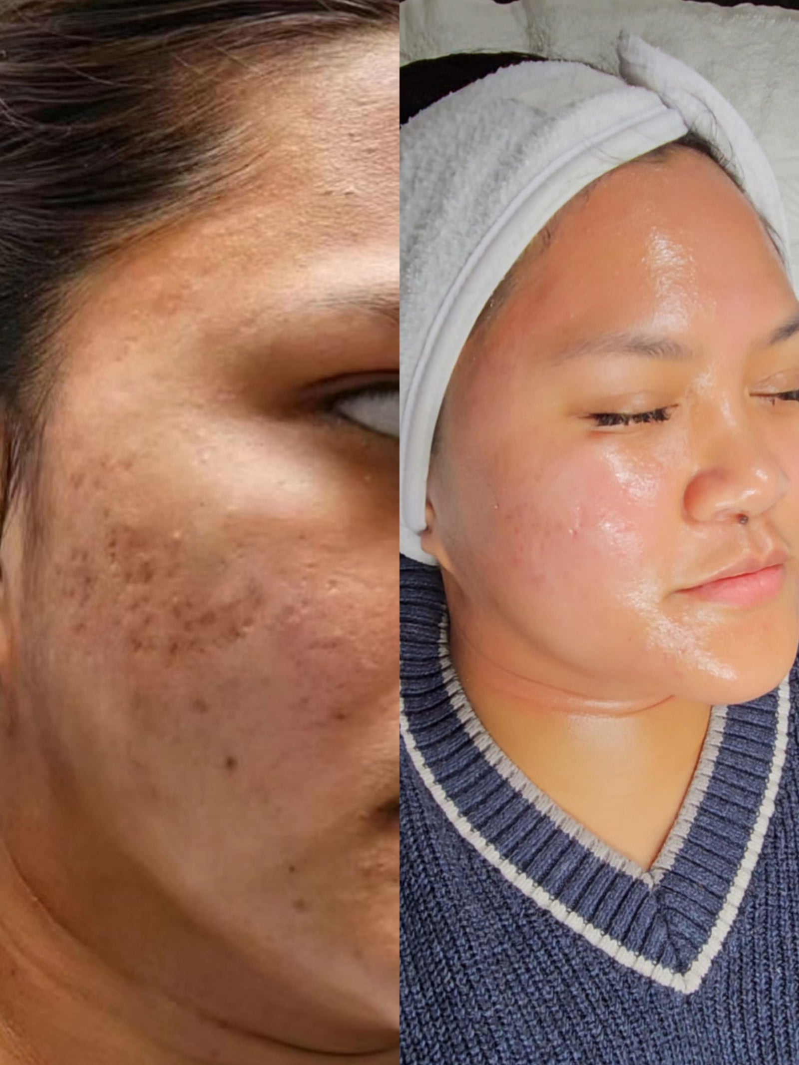 HEXIE Beauty client result or treatment in progress