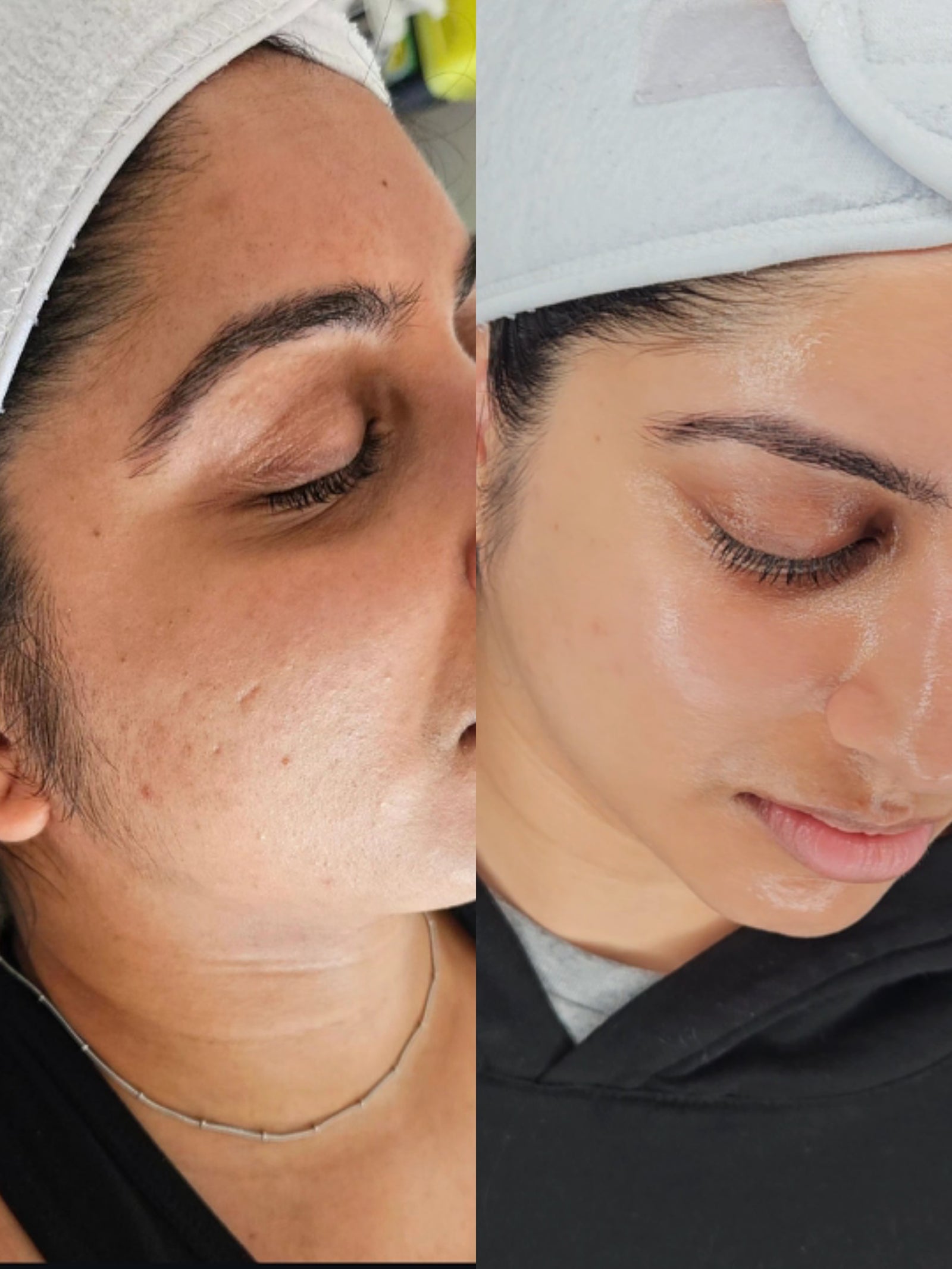 HEXIE Beauty client result or treatment in progress