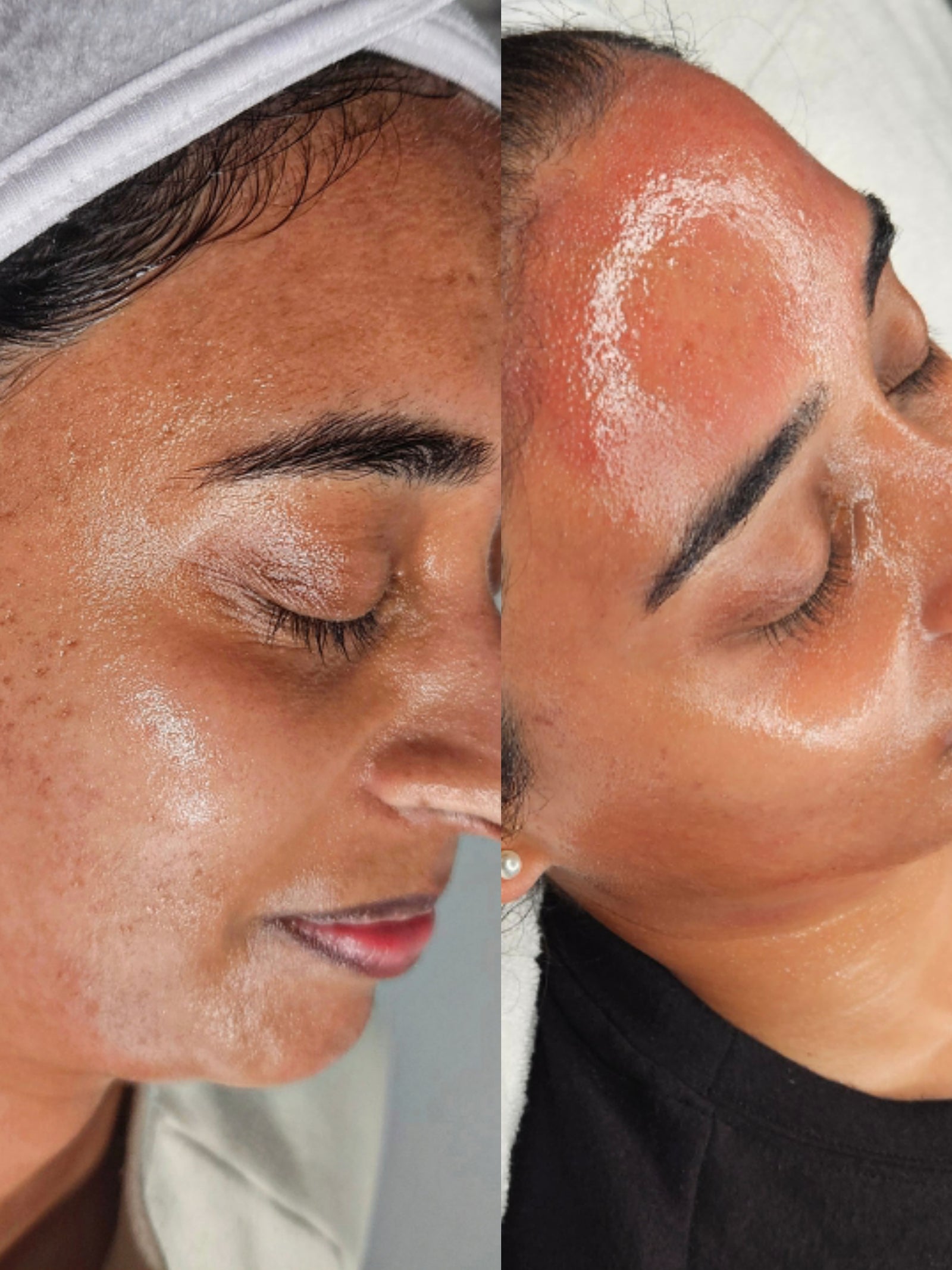 HEXIE Beauty client result or treatment in progress