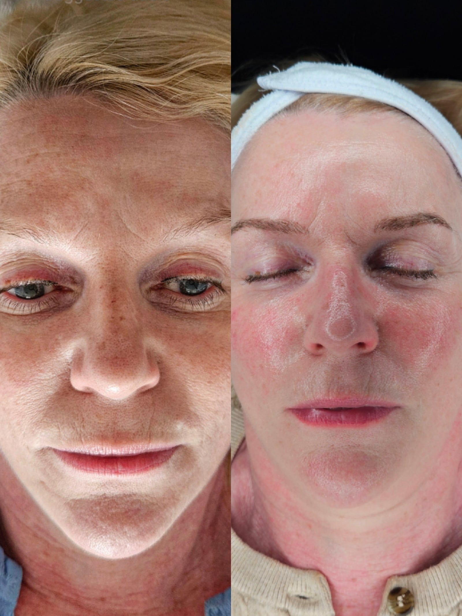 HEXIE Beauty client result or treatment in progress