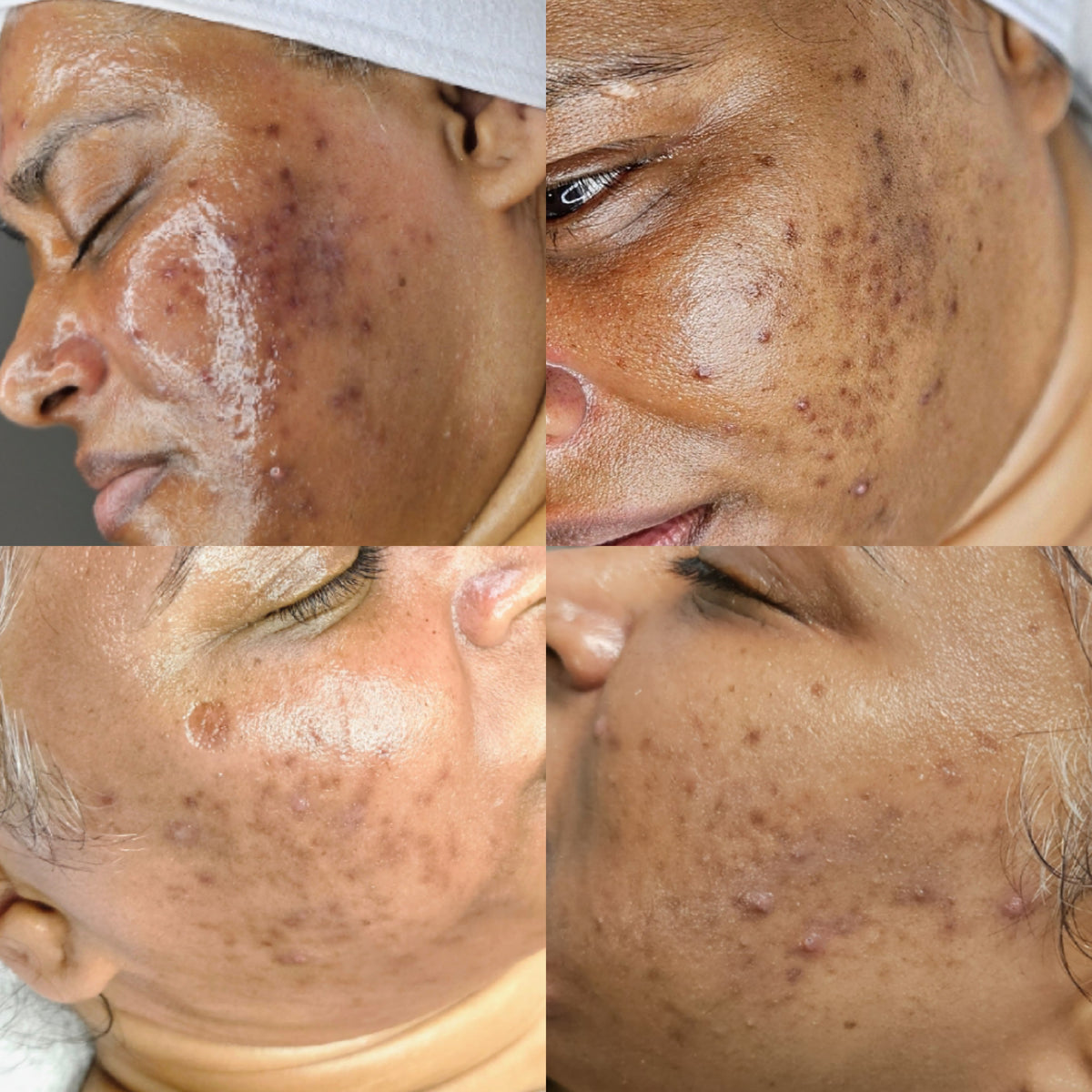 HEXIE Beauty client skin result, gallery image 3