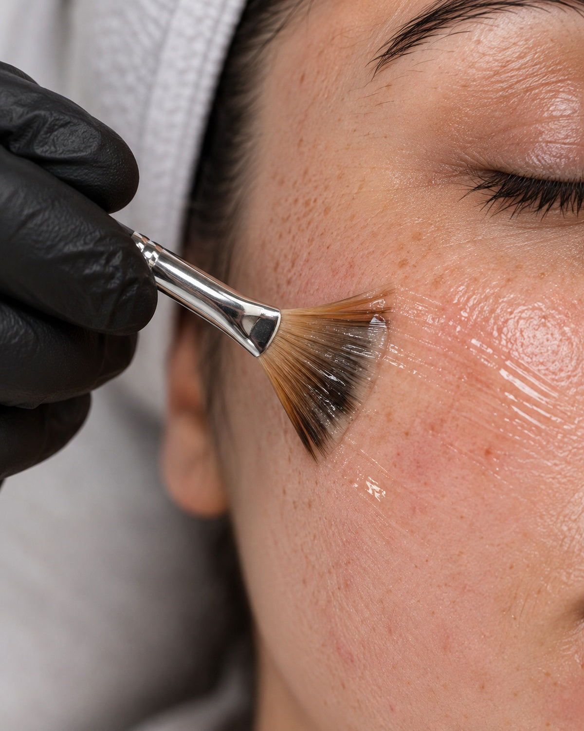 Skin Peel
