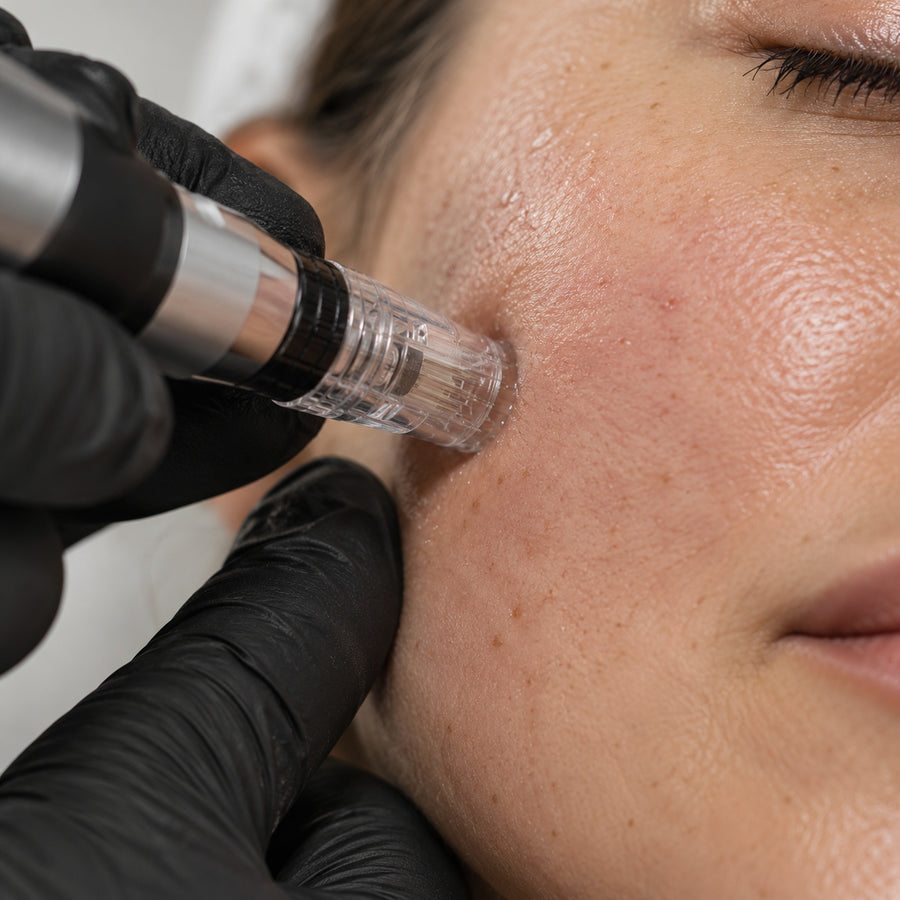 Microneedling